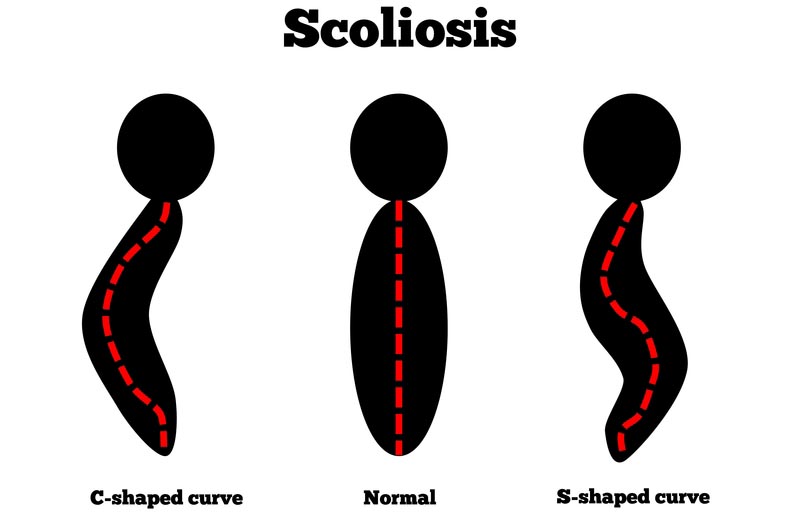 Pflugerville, TX scoliosis treatment